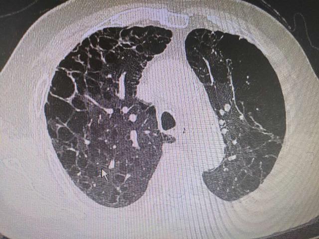 ct上满肺都是大泡泡,原因居然和这个有关|肺气肿|ct|慢阻肺|二氧化碳