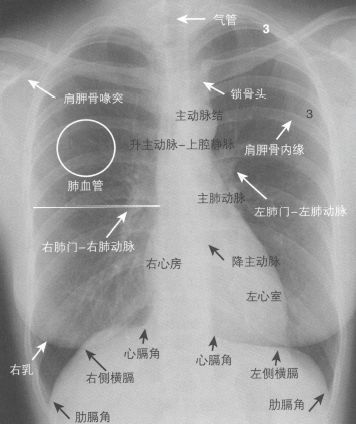 x线侧位胸片的"5个关键区域",诊断误区及解决方案