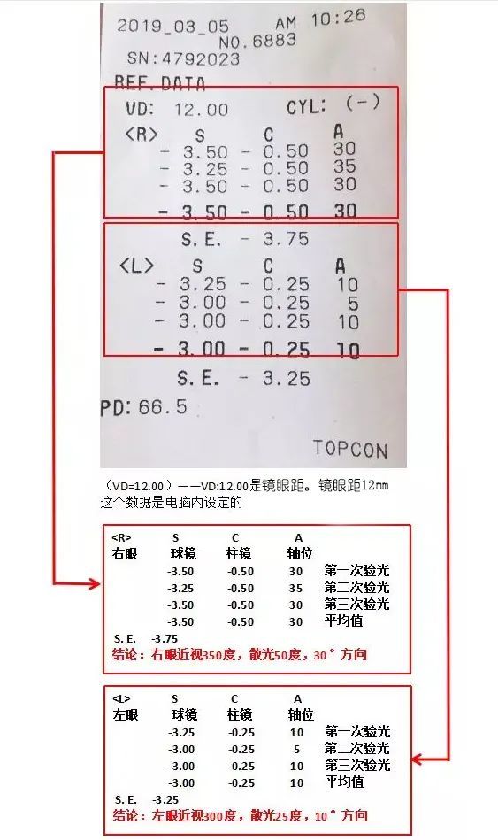 孩子的验光单看不懂?视光师教你轻松读懂