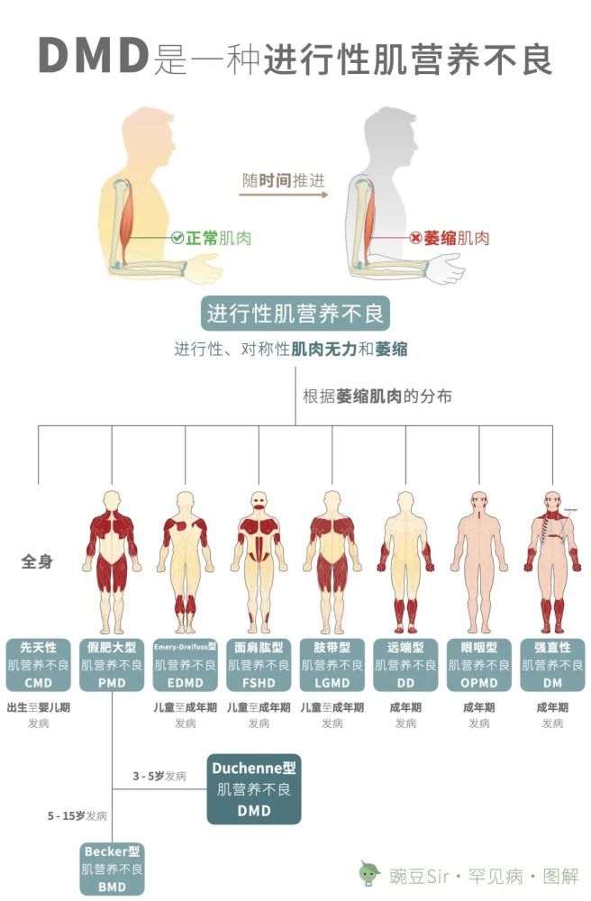 假肥大型进行性肌营养不良(dmd,duchennemusculardystrophhy),又称为