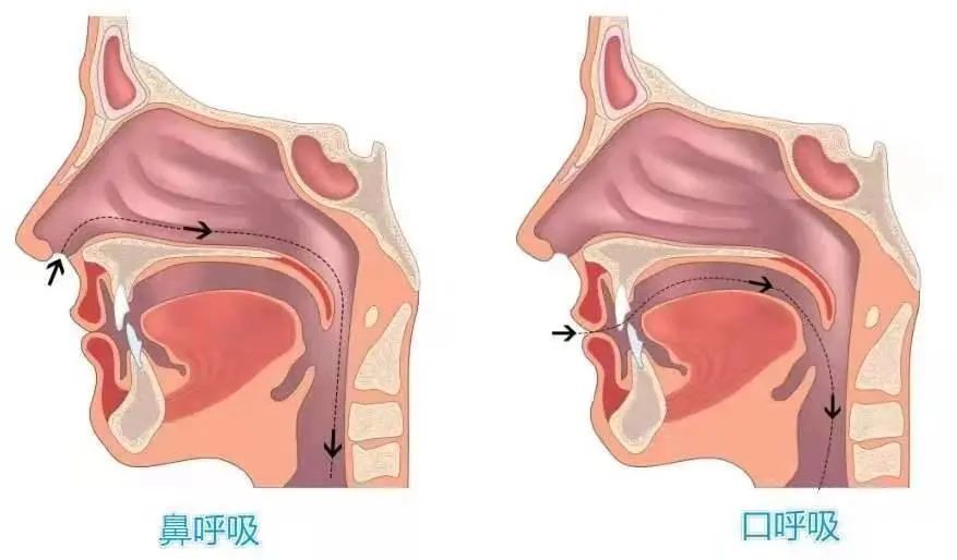 影响面型 长期用口呼吸,气流长期经过口腔冲击硬腭,会使其变形.