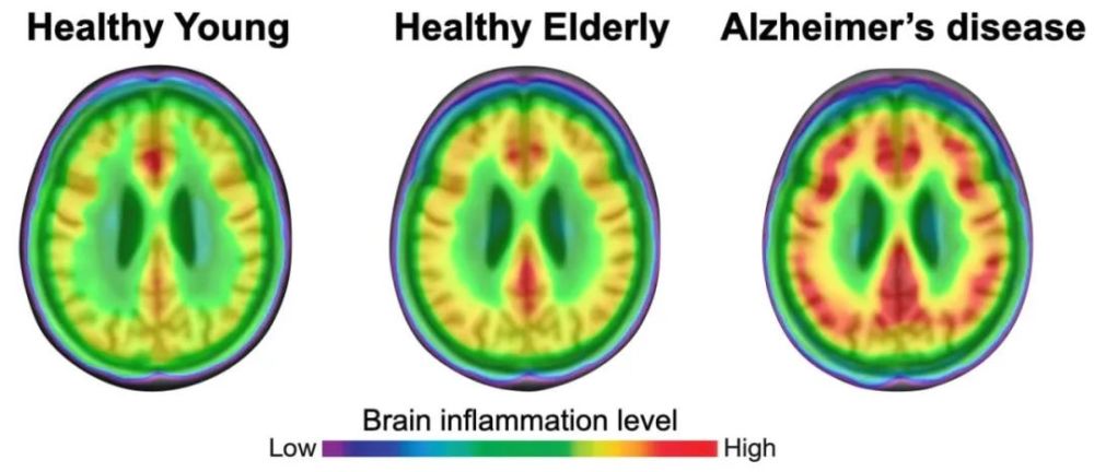 神经炎症促发阿尔茨海默病?新研究首次在活人大脑中找到证据!