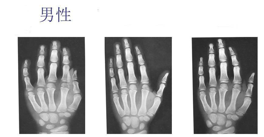 儿科医生教你简单识别孩子的骨龄片,关注 身高,警惕早熟