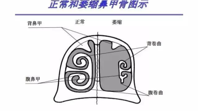 头痛,头昏:由于鼻甲萎缩,鼻腔缺乏调温保温作用,吸入冷空气刺激鼻粘膜