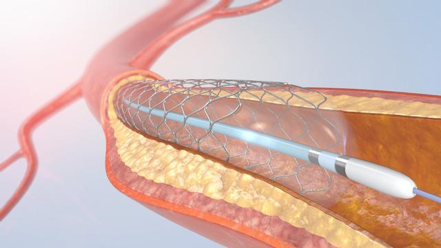做完心脏支架患者就活不久了医生说出答案
