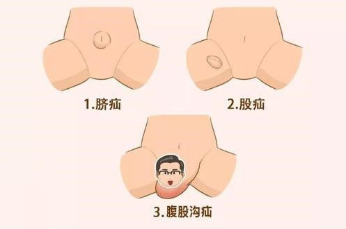 医生:疝气不是气,和氧气,氮气没半毛钱关系哦!