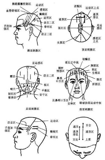 痹证头针疗法