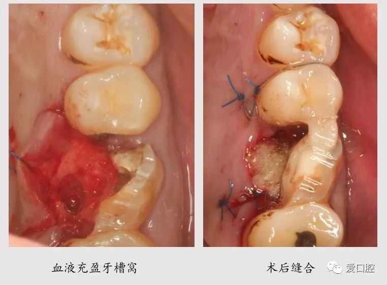 牙体半切除术在上颌后牙的应用1例