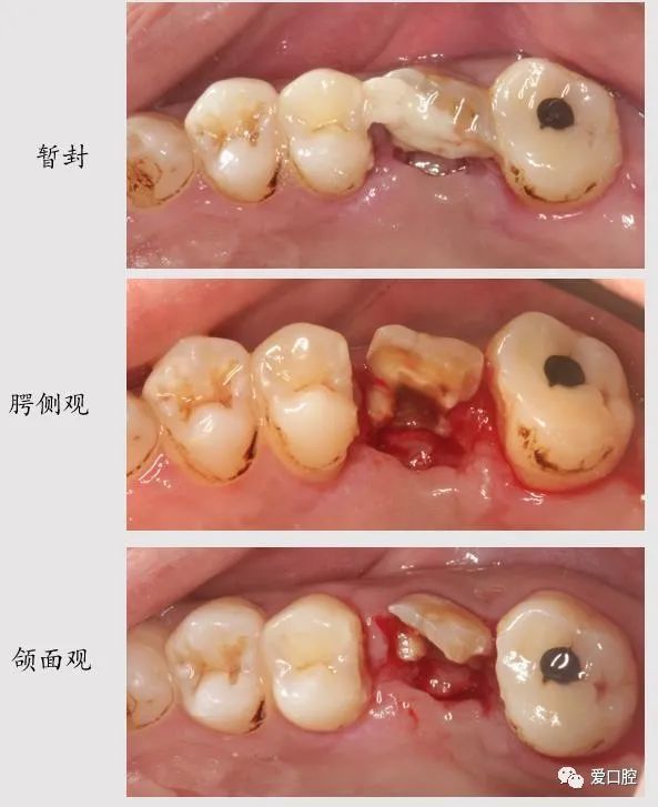 牙体半切除术在上颌后牙的应用1例