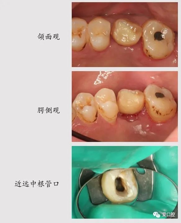 颌面暂封物,疏通mb db根管 ,15号c锉为初尖锉 mb=17mm,(洞缘为起点)