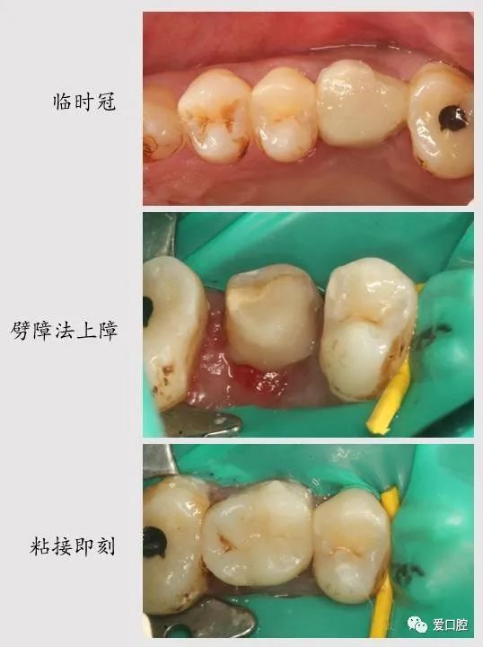 检查:26见临时冠修复 叩(-) 松动(-) 第八次治疗:26取出临时冠,上障