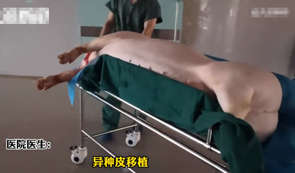 河南一医院给烧伤病人移植猪皮为他省钱手术后猪肉送回屠宰场
