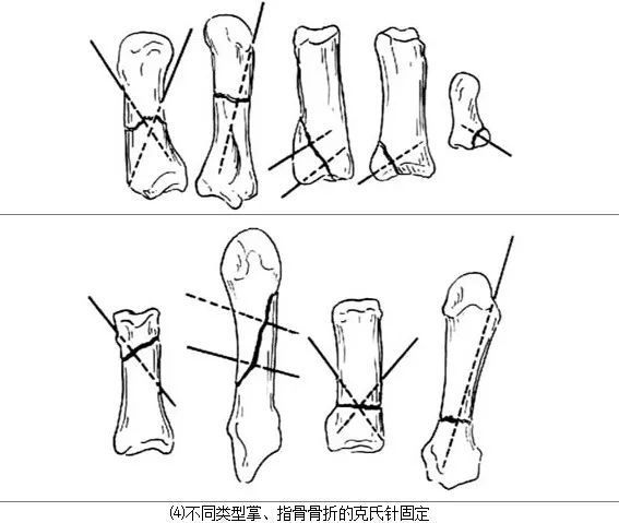 其他部位骨折和不同类型骨折的克氏针固定如图所示[图2 ].5.