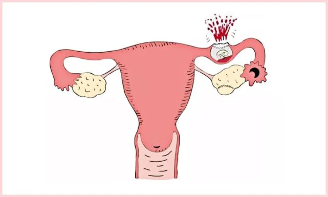 月经不调,结婚前夕她被切除了输卵管
