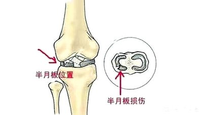 半月板损伤要不要手术治疗?