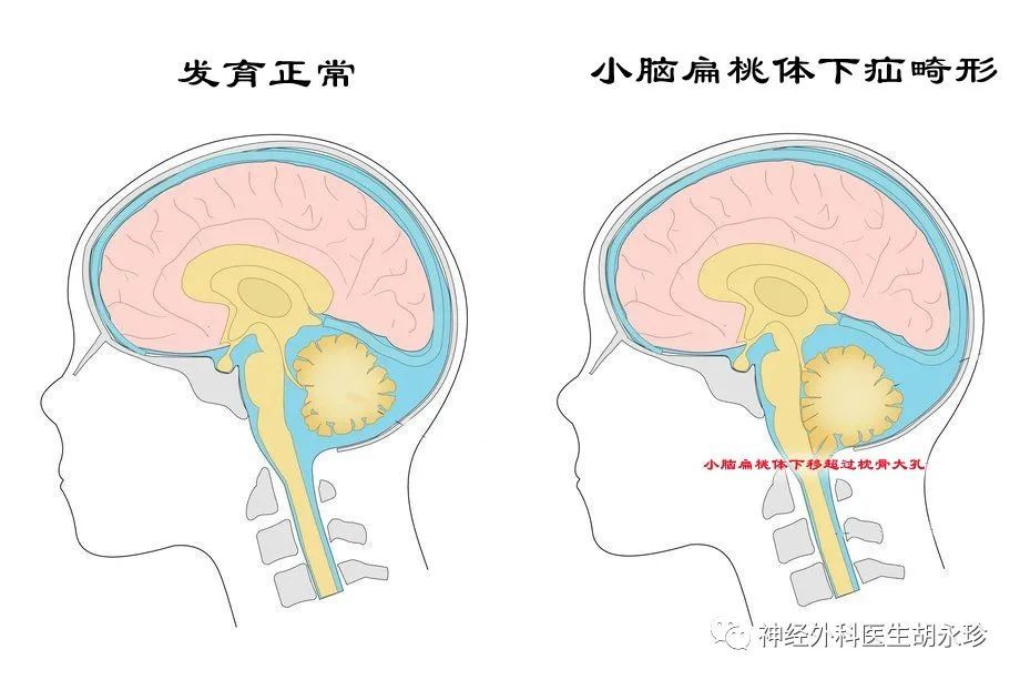 长时间头颈痛,眩晕,走路不稳,当心小脑扁桃体下疝畸形