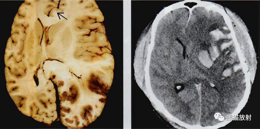 脑疝,脑死亡—影像诊断详细篇!_腾讯新闻