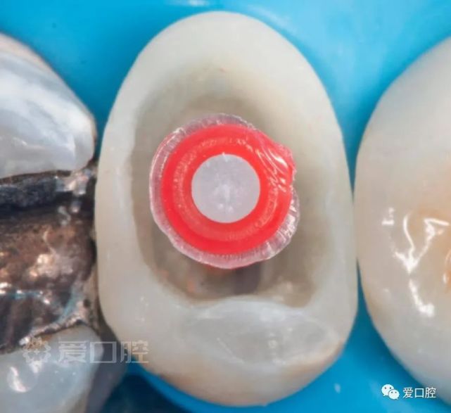 上颌第二前磨牙rct 纤维桩 冠修复1例