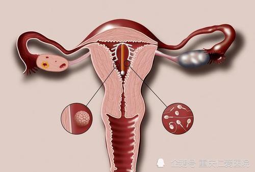 重庆仁爱妇科医院分享女人上环有哪些注意事项呢