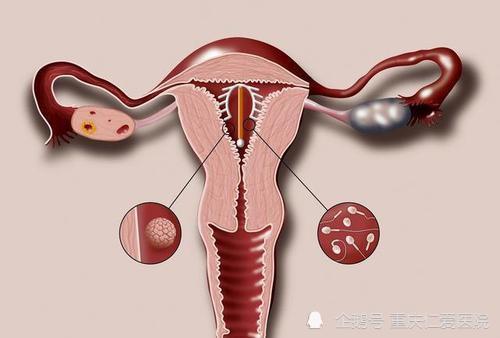 重庆仁爱妇科医院分享:女人上环有哪些注意事项呢