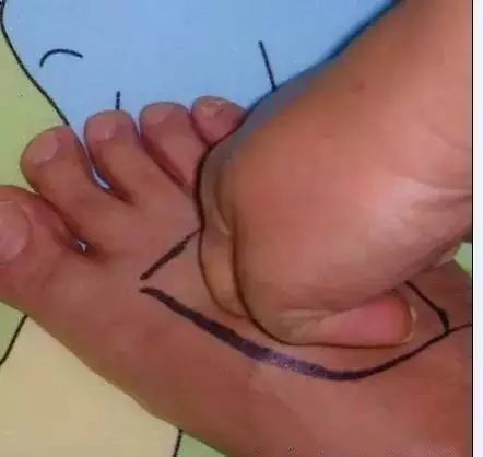 乳腺增生怎样治愈（乳腺增生怎样治愈有什么偏方）