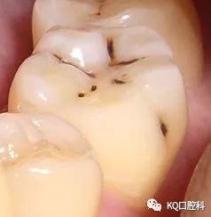 牙齿表面有擦不掉的小黑点或黑线,就表示