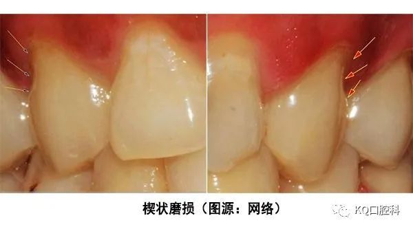 蚀症,其定义为"由于持续存在的化学作用所造成的牙齿表层的组织丧失