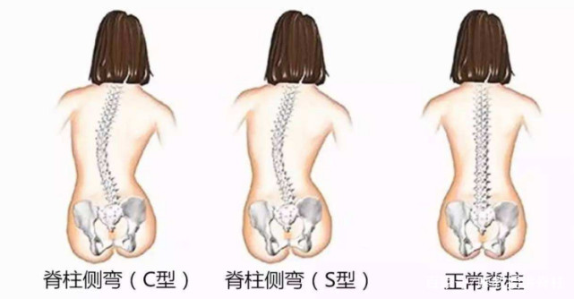专家教你4个方法鉴别孩子有没有脊柱侧弯