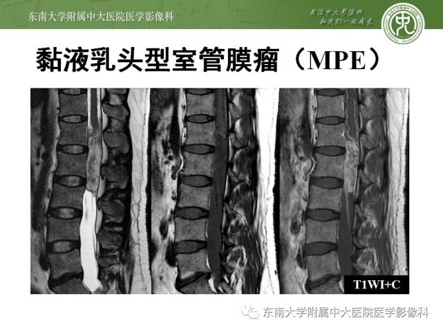 脊髓室管膜瘤
