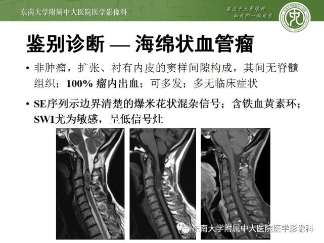 脊髓室管膜瘤