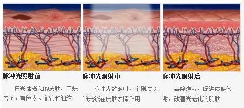 怎样治疗痤疮（怎样治疗痤疮比较好）