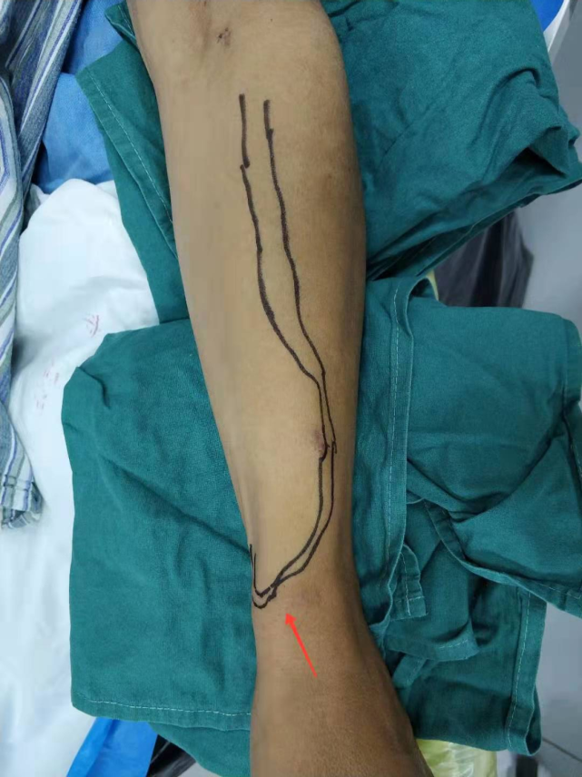 影像学检查:超声提示前臂桡动脉-头静脉吻合口狭窄,前臂头静脉内无