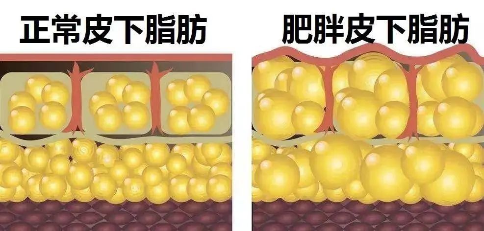 当某些脂肪细胞的体积增大,数量变多,那么人体就不可避免地臃肿起来了