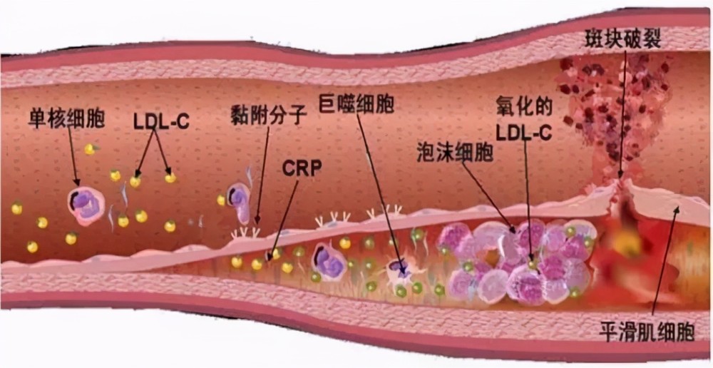 冠心病什么症状（冠心病什么症状表现）