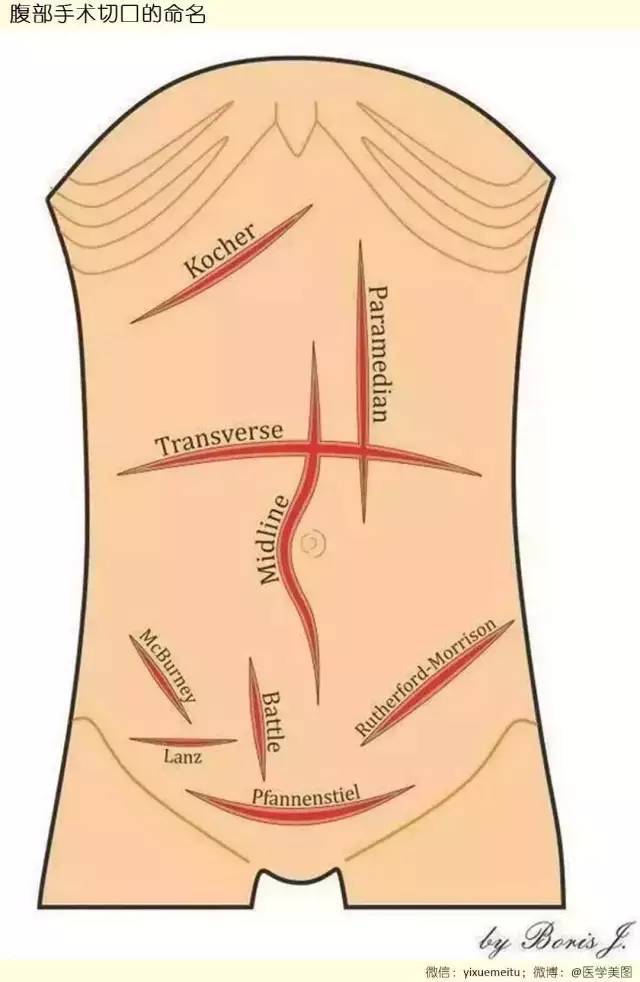 腹部手术切口,你都认全了吗?