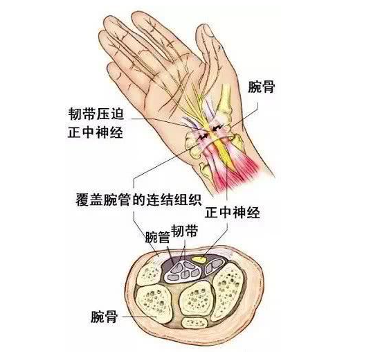 夜间手指麻木很多时候是腕管综合征的首发症状,许多患者均有夜间手指