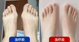 拇外翻该怎么治疗（拇外翻最好的治疗方法是什么_）