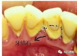 牙结石是什么味道的?