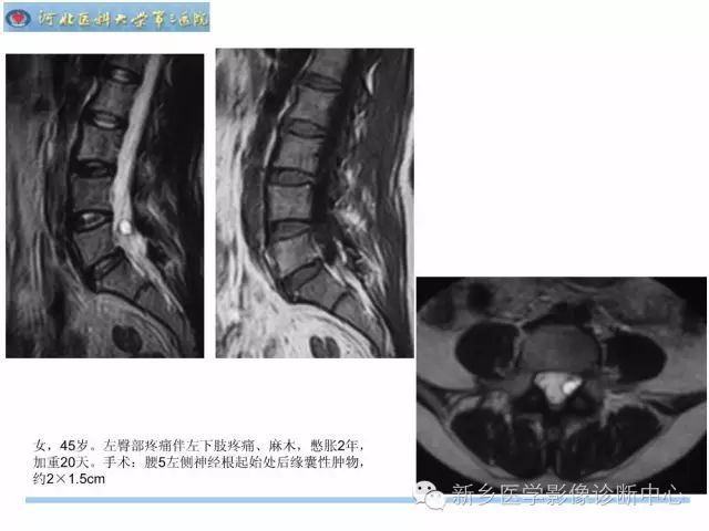 椎管内囊肿