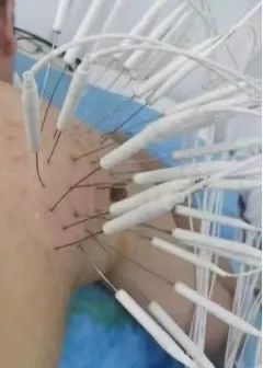 银质针疗法你值得拥有!