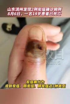 与感染途径相对应,炭疽主要有三种临床类型:皮肤炭疽,肺炭疽和肠炭疽.