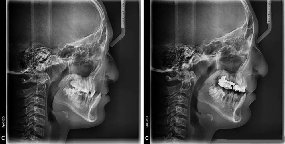 兔唇怎么治疗（兔唇怎么修复）