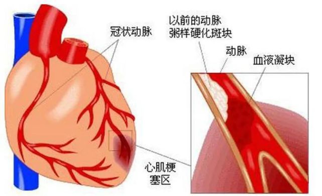 当心心肌缺血,赶快去医院检查