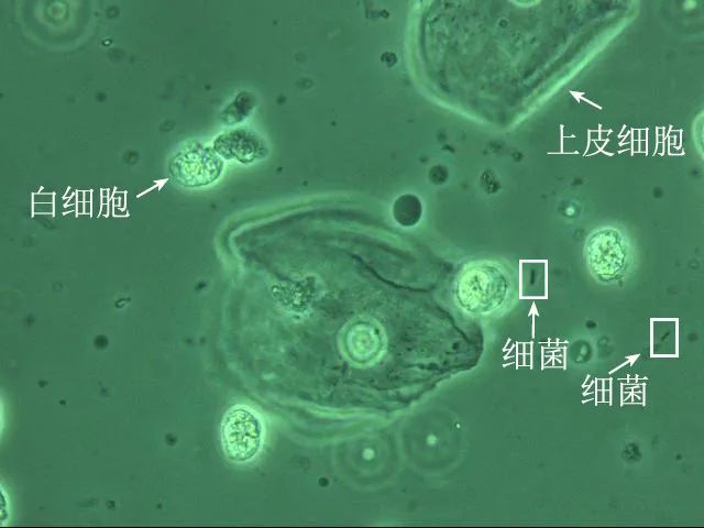 的手段主要为白带常规检验,其内容主要为阴道清洁度,ph值,线索细胞