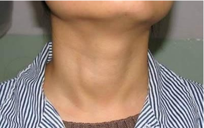 颈部出现的3种状况,要注意是不是甲状腺癌找上你!