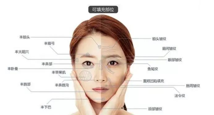 通常,面部三角区会采用玻尿酸填充,而面部其他区域则采用自体脂肪填充