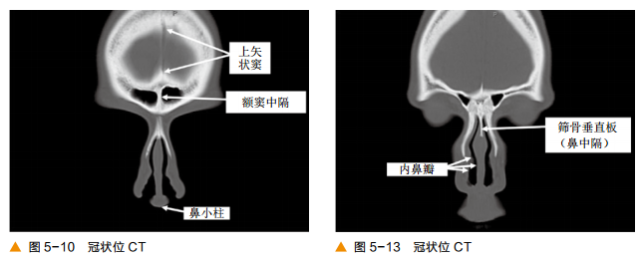 前后筛窦以中鼻甲基板为界,蝶窦及后组筛窦以上鼻甲基板为界.