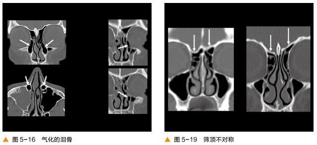 二,冠状位图像一,轴位图像颅底ct及鼻窦解剖