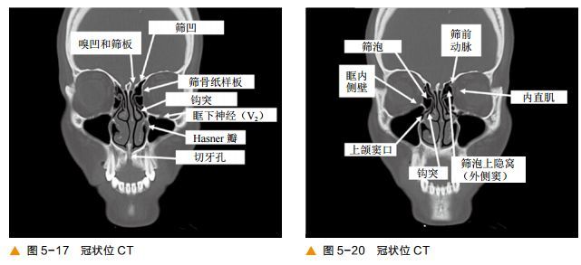 前后筛窦以中鼻甲基板为界,蝶窦及后组筛窦以上鼻甲基板为界.