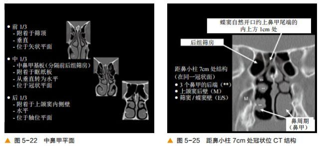 前后筛窦以中鼻甲基板为界,蝶窦及后组筛窦以上鼻甲基拔 .